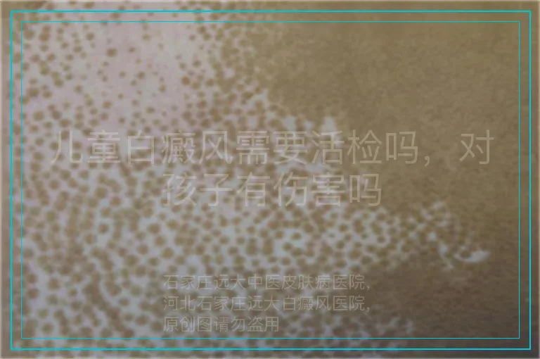 儿童白癜风需要活检吗，对孩子有伤害吗