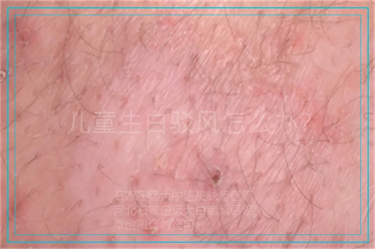 儿童生白驳风怎么办？