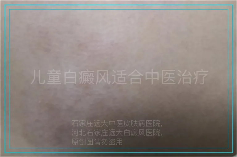 儿童白癜风适合中医治疗