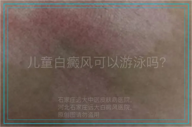 儿童白癜风可以游泳吗？