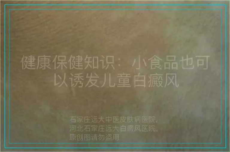 健康保健知识：小食品也可以诱发儿童白癜风