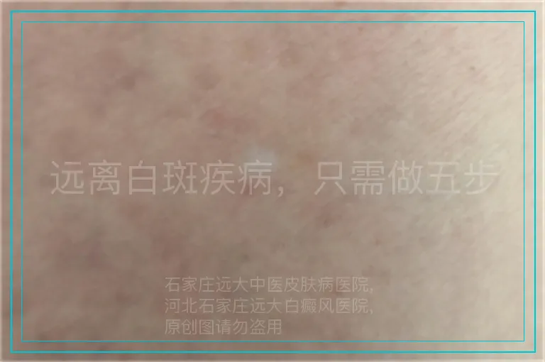 远离白斑疾病，只需做五步