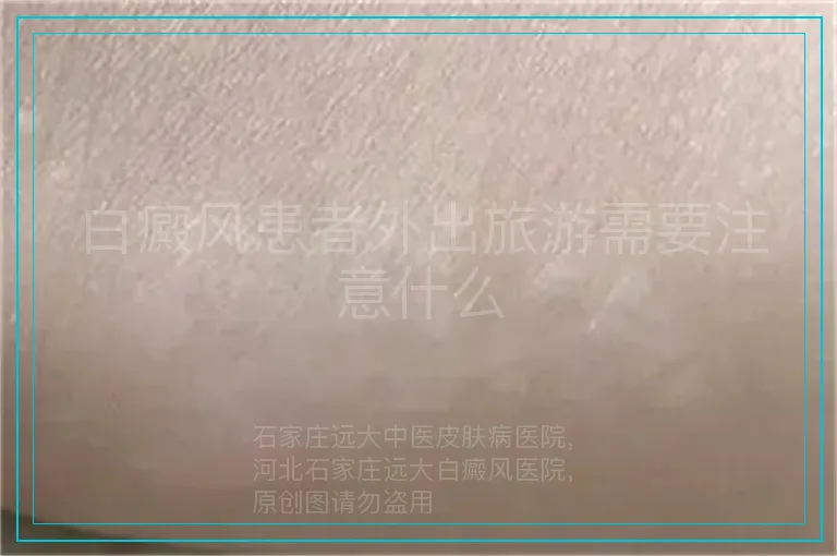 白癜风患者外出旅游需要注意什么