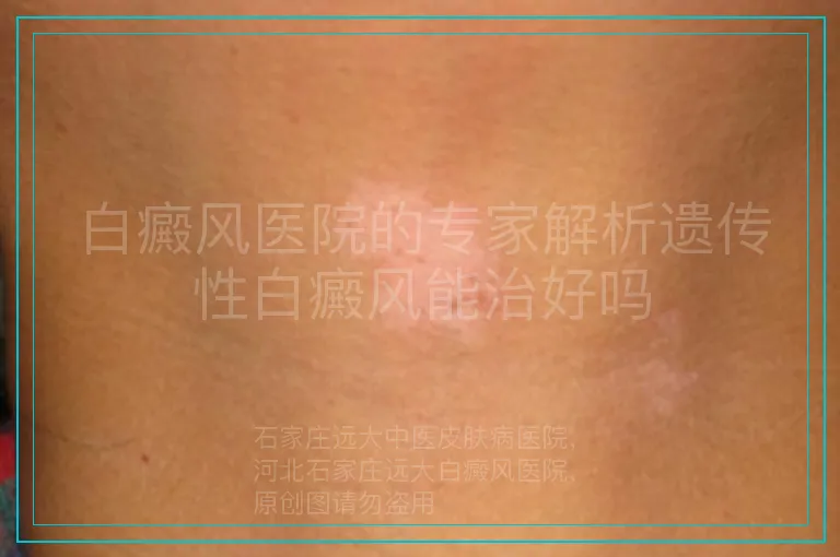 白癜风医院的专家解析遗传性白癜风能治好吗