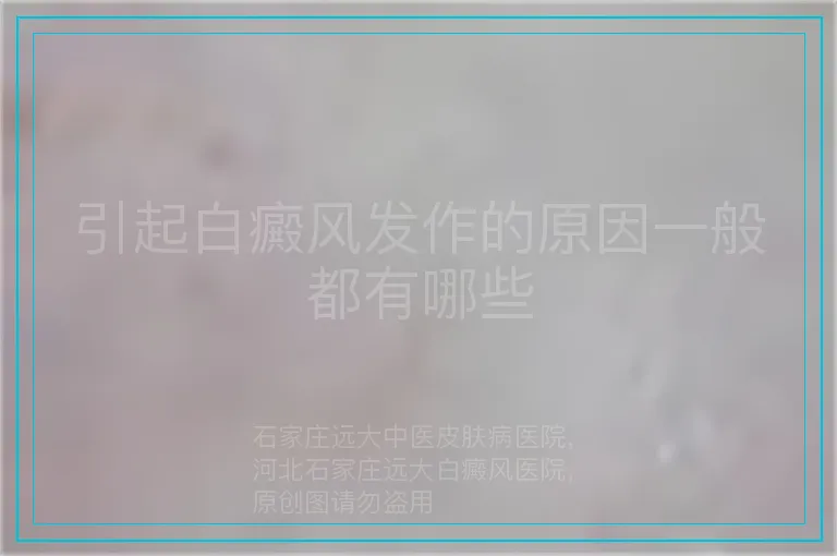 引起白癜风发作的原因一般都有哪些