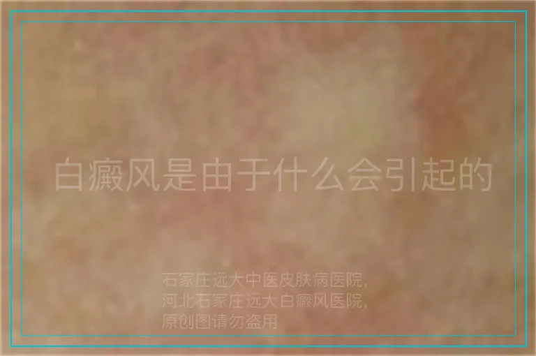 白癜风是由于什么会引起的