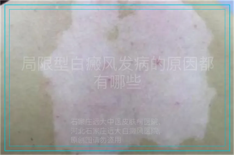 局限型白癜风发病的原因都有哪些