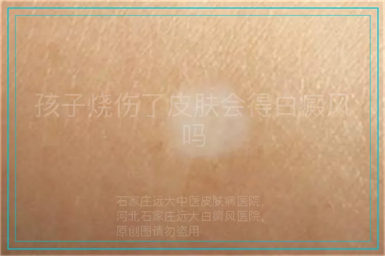 孩子烧伤了皮肤会得白癜风吗