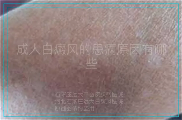 成人白癜风的患病原因有哪些
