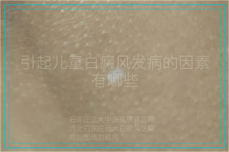 引起儿童白癜风发病的因素有哪些
