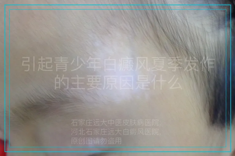 引起青少年白癜风夏季发作的主要原因是什么