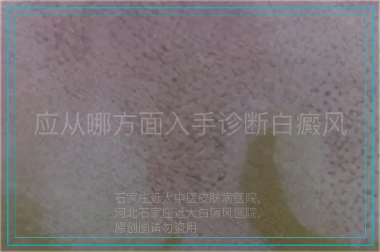 应从哪方面入手诊断白癜风