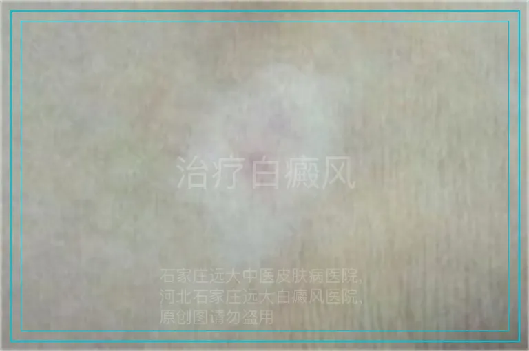 治疗白癜风