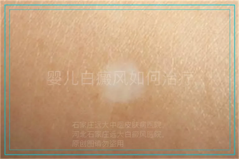 婴儿白癜风如何治疗