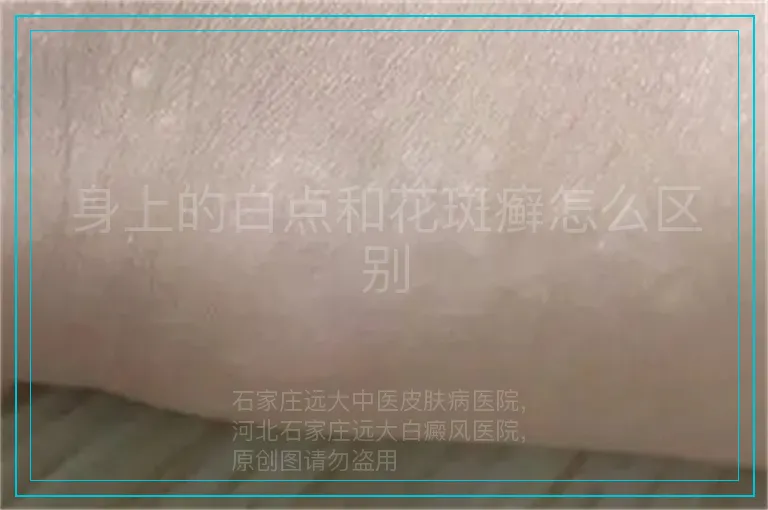 身上的白点和花斑癣怎么区别