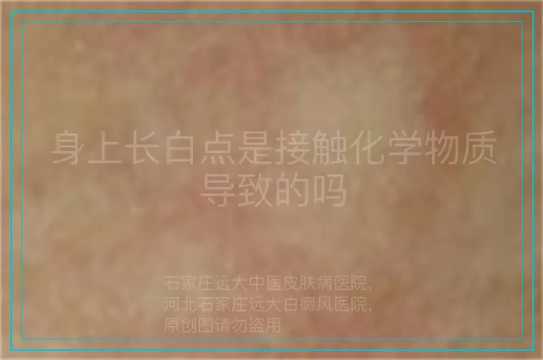 身上长白点是接触化学物质导致的吗