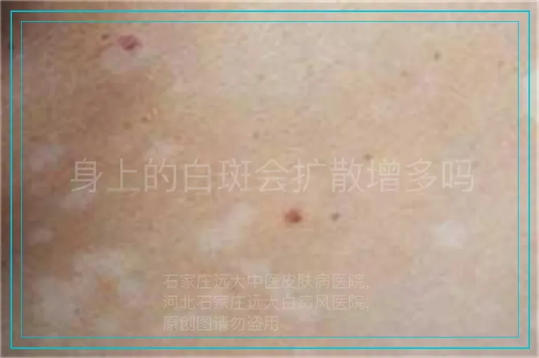 身上的白斑会扩散增多吗