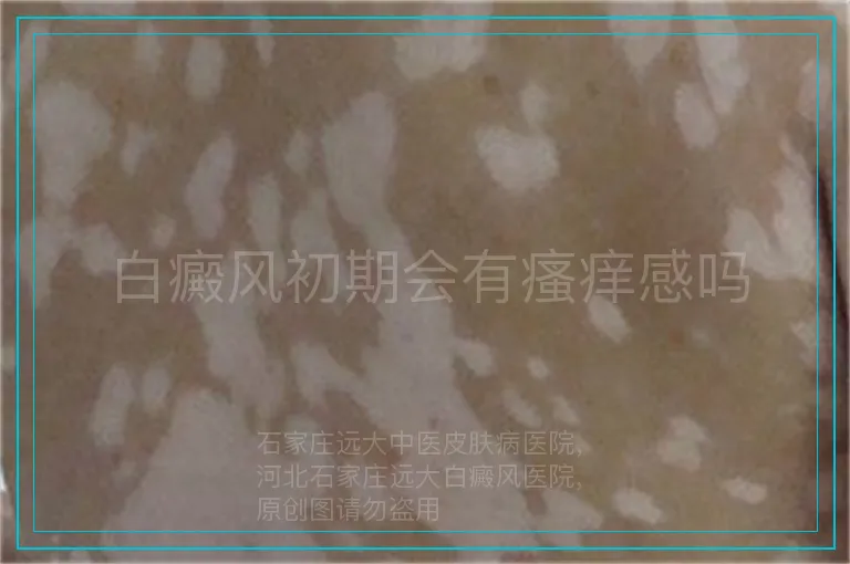 白癜风初期会有瘙痒感吗