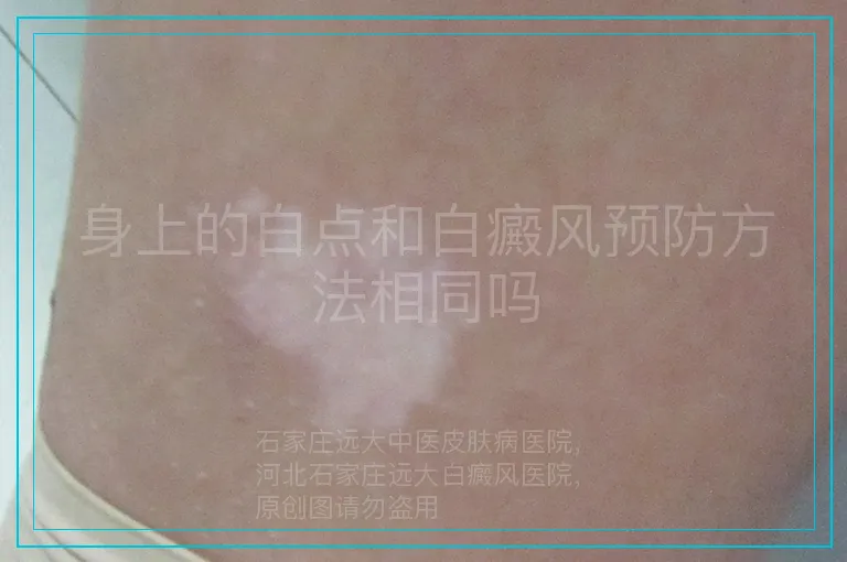 身上的白点和白癜风预防方法相同吗