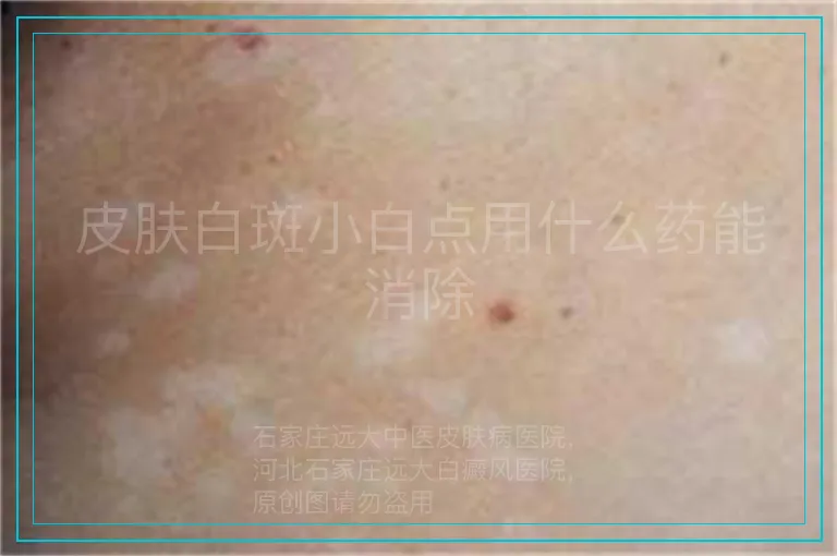 皮肤白斑小白点用什么药能消除