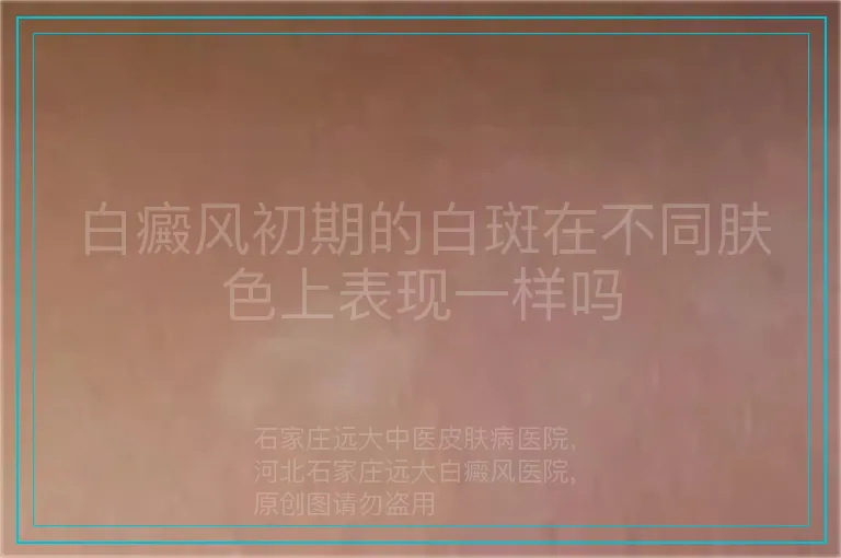 白癜风初期的白斑在不同肤色上表现一样吗