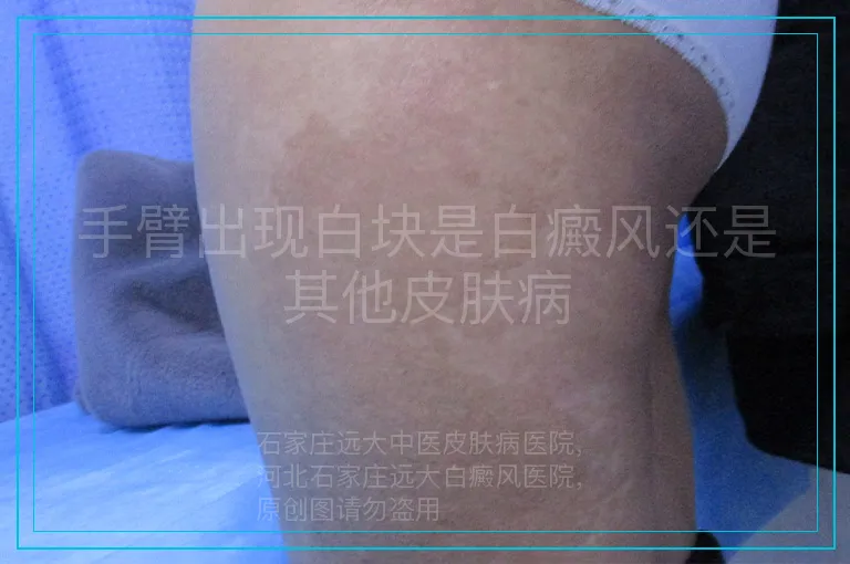 手臂出现白块是白癜风还是其他皮肤病