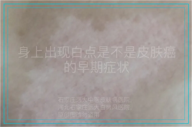 身上出现白点是不是皮肤癌的早期症状
