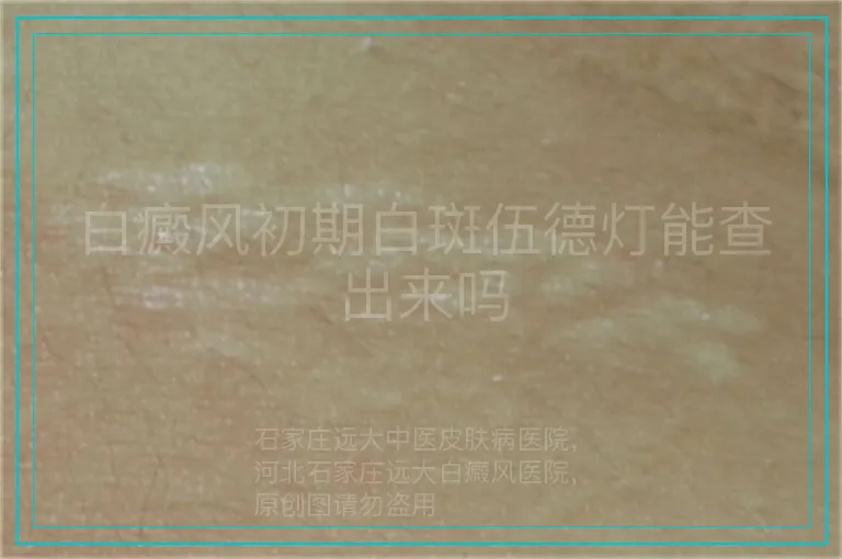 白癜风初期白斑伍德灯能查出来吗