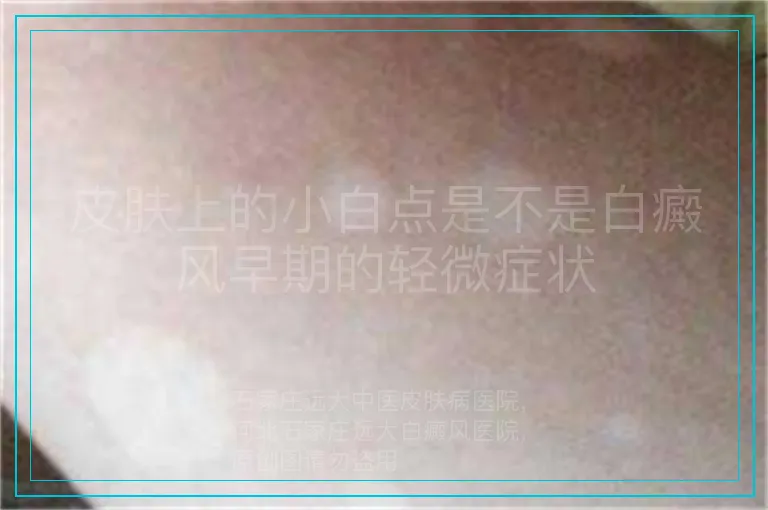 皮肤上的小白点是不是白癜风早期的轻微症状