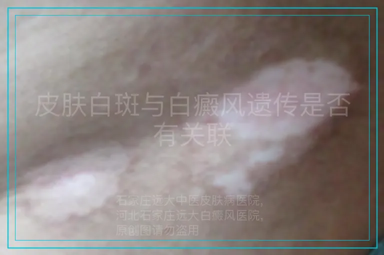 皮肤白斑与白癜风遗传是否有关联