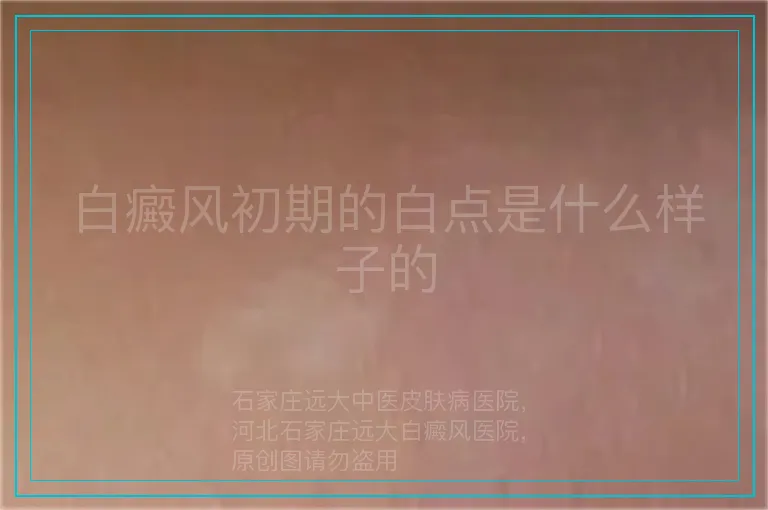 白癜风初期的白点是什么样子的