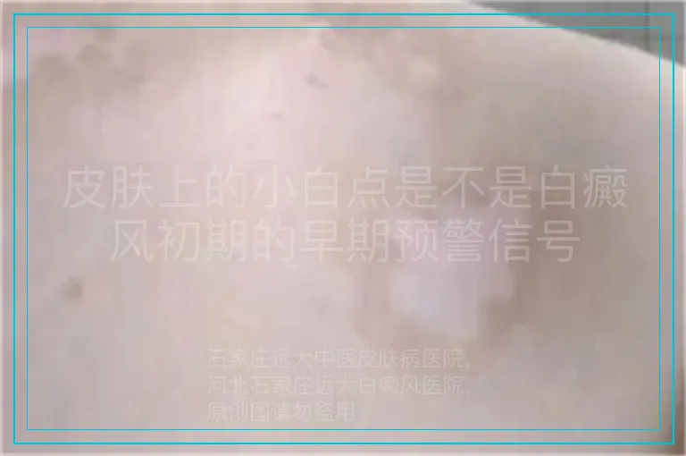 皮肤上的小白点是不是白癜风初期的早期预警信号