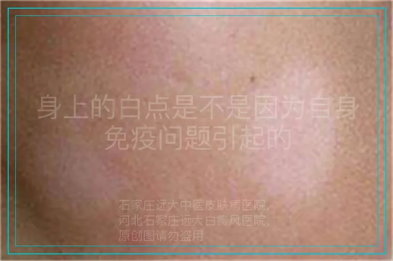 身上的白点是不是因为自身免疫问题引起的