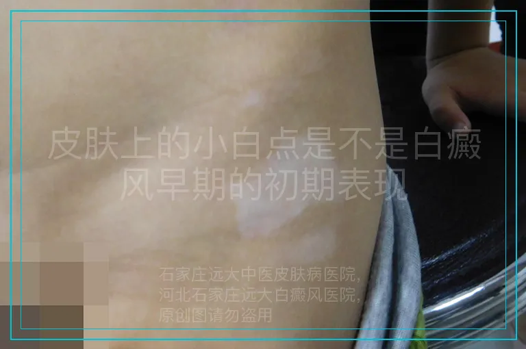 皮肤上的小白点是不是白癜风早期的初期表现