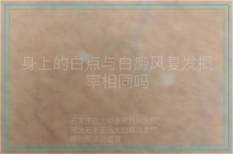 身上的白点与白癜风复发概率相同吗