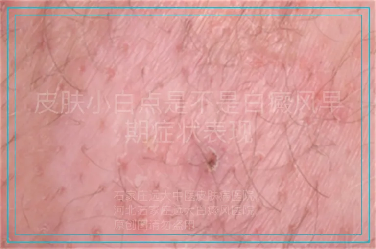 皮肤小白点是不是白癜风早期症状表现