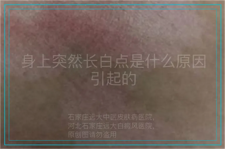 身上突然长白点是什么原因引起的