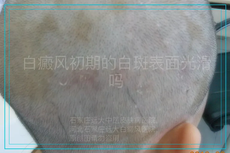 白癜风初期的白斑表面光滑吗