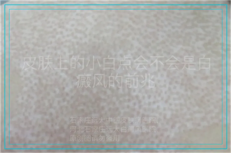 皮肤上的小白点会不会是白癜风的前兆