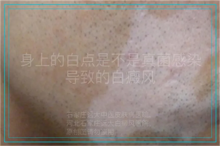 身上的白点是不是真菌感染导致的白癜风