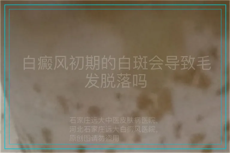 白癜风初期的白斑会导致毛发脱落吗