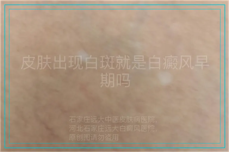 皮肤出现白斑就是白癜风早期吗