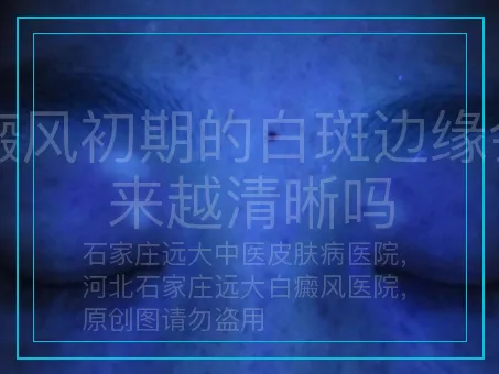 白癜风初期的白斑边缘会越来越清晰吗