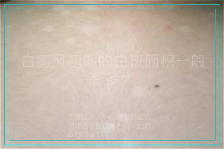 白癜风初期的白斑面积一般有多大