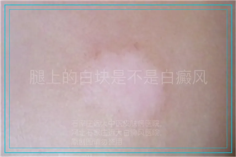 腿上的白块是不是白癜风