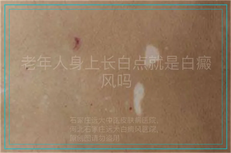 老年人身上长白点就是白癜风吗