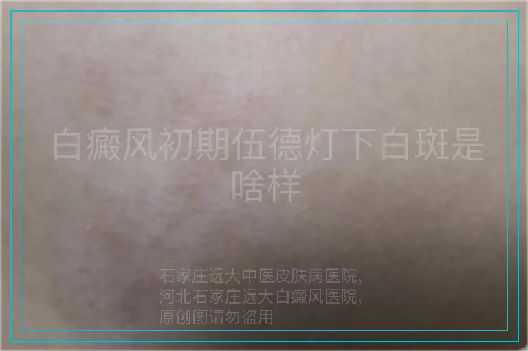 白癜风初期伍德灯下白斑是啥样