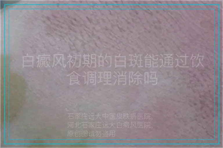 白癜风初期的白斑能通过饮食调理消除吗