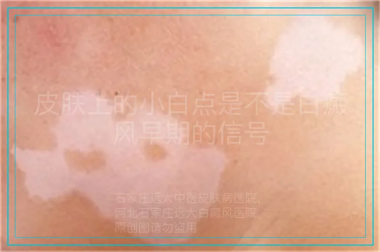 皮肤上的小白点是不是白癜风早期的信号