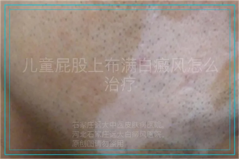 儿童屁股上布满白癜风怎么治疗